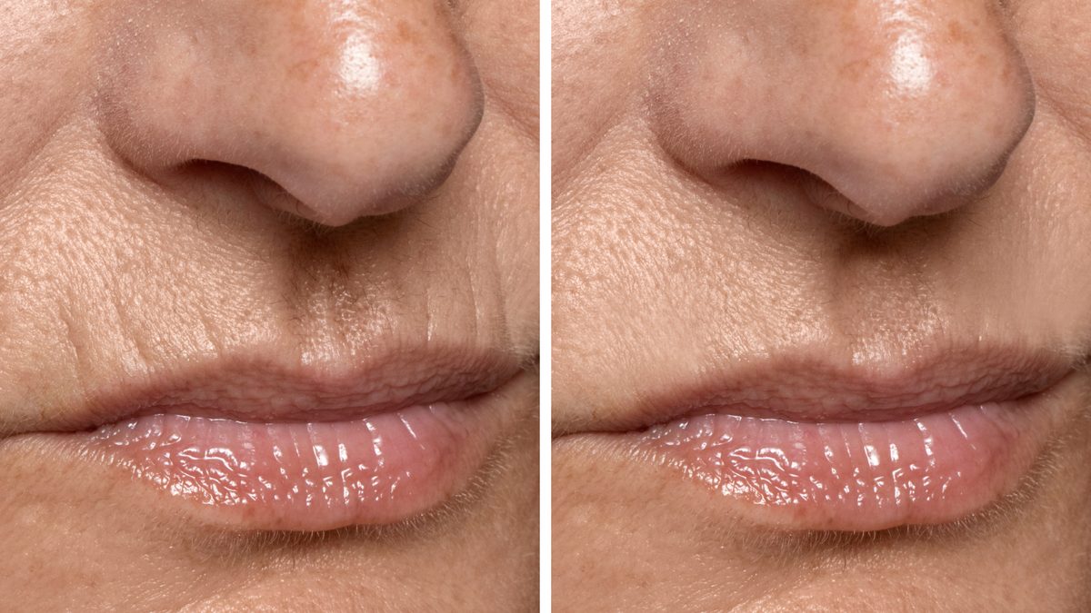 belotero-dermal-filler-lip-enhancement
