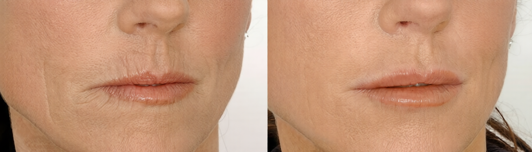 Belotero Dermal Filler Treatment before and after smoothing smile lines and enhancing lips.