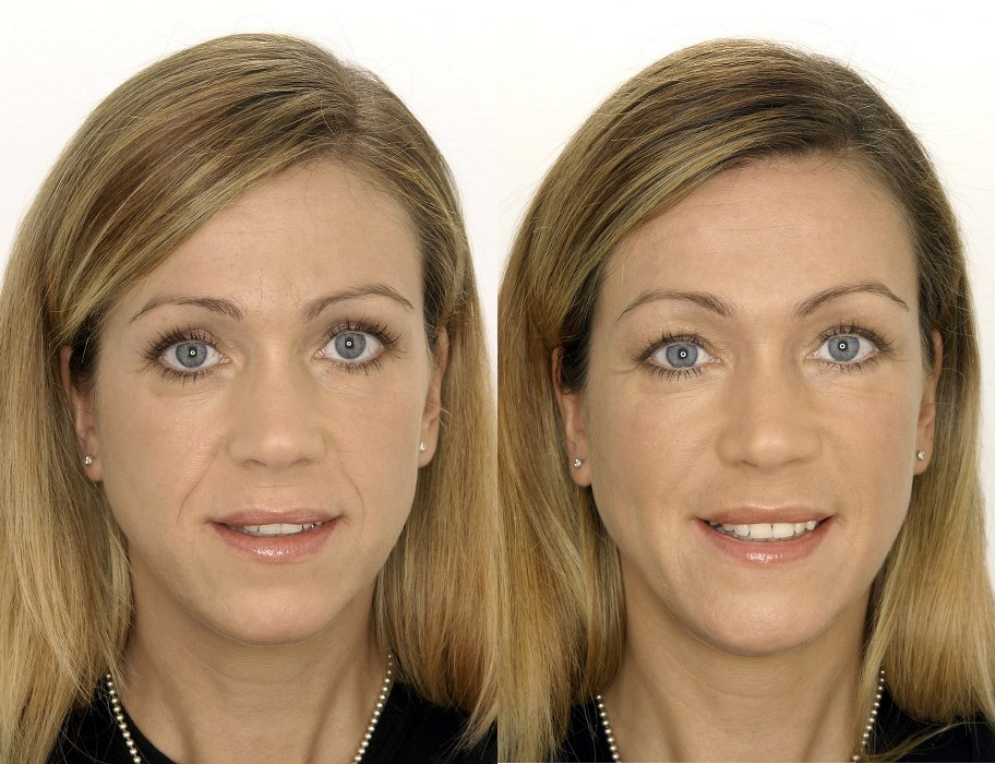 Belotero Dermal Filler Treatment before and after, enhancing facial volume and smoothing skin.