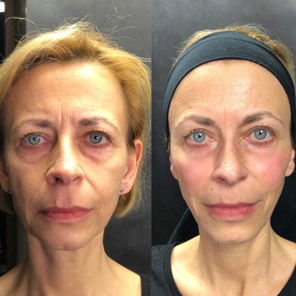 Before and after Dermal Filler Facelift treatment enhancing facial volume and smoothing wrinkles.