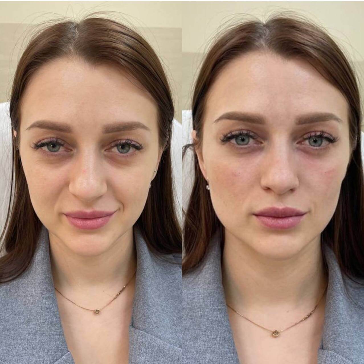 Ellansé filler treatment before and after showing improved cheeks and under eye area.