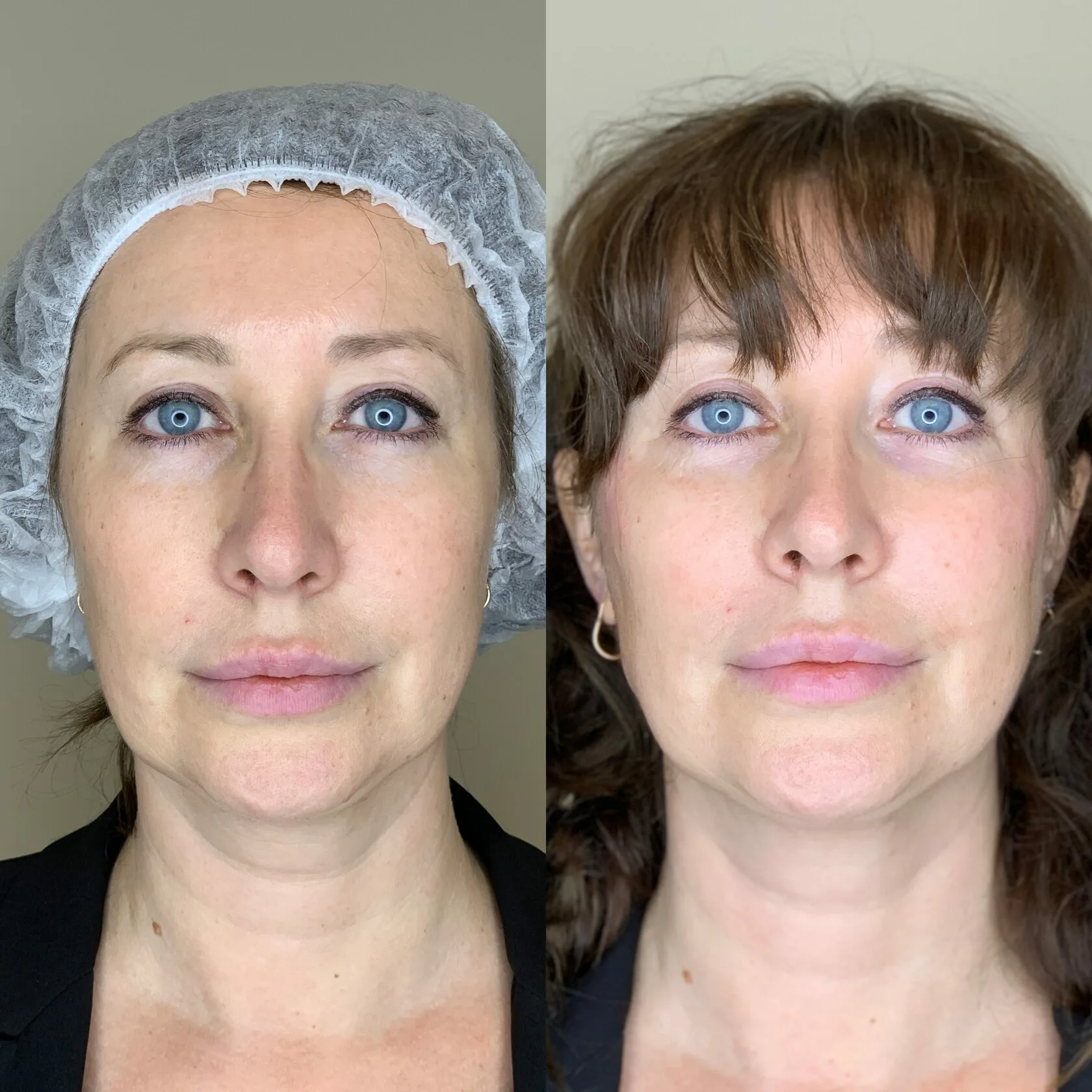 Ellansé filler treatment before and after full face with enhanced volume and smoother skin.