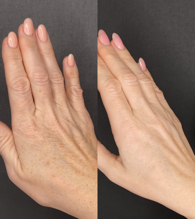 ellanse-filler-treatment-before-after-hands