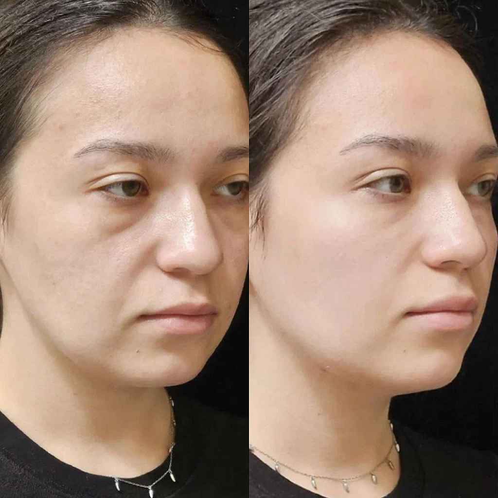 ellanse-filler-treatment-before-after-nasolabial-folds