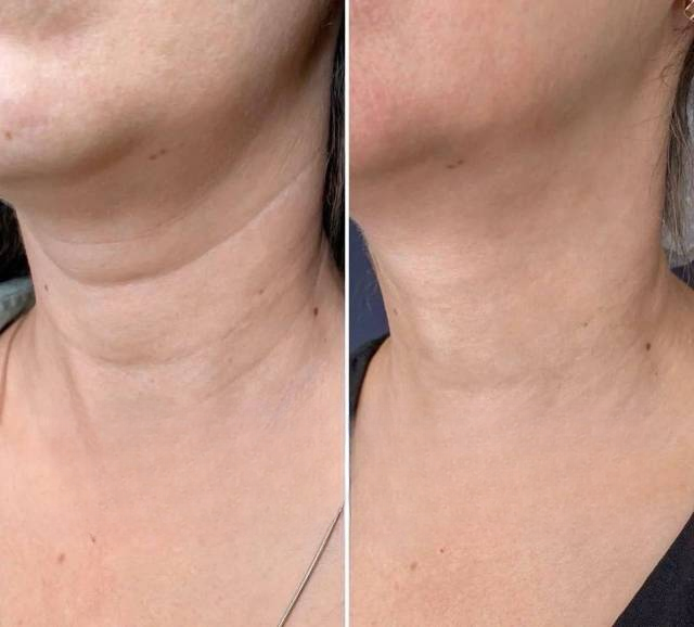 Ellansé filler treatment before and after reducing neck lines and improving skin texture.