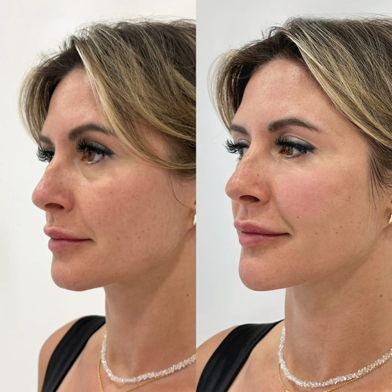 Before and after Eye Filler Treatment enhancing the under-eye area for a refreshed and youthful look.