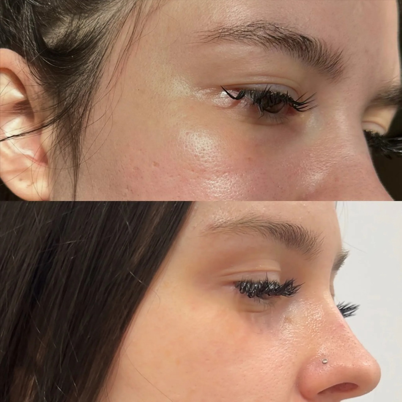 filler-dissolving-treatment-eye-area-reduction