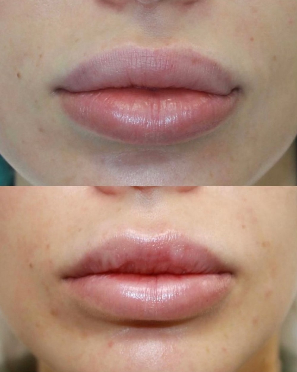 filler-dissolving-treatment-lip-reduction-result