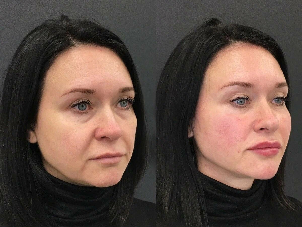 Kairax Filler Treatment before and after showing enhanced facial features and volume.