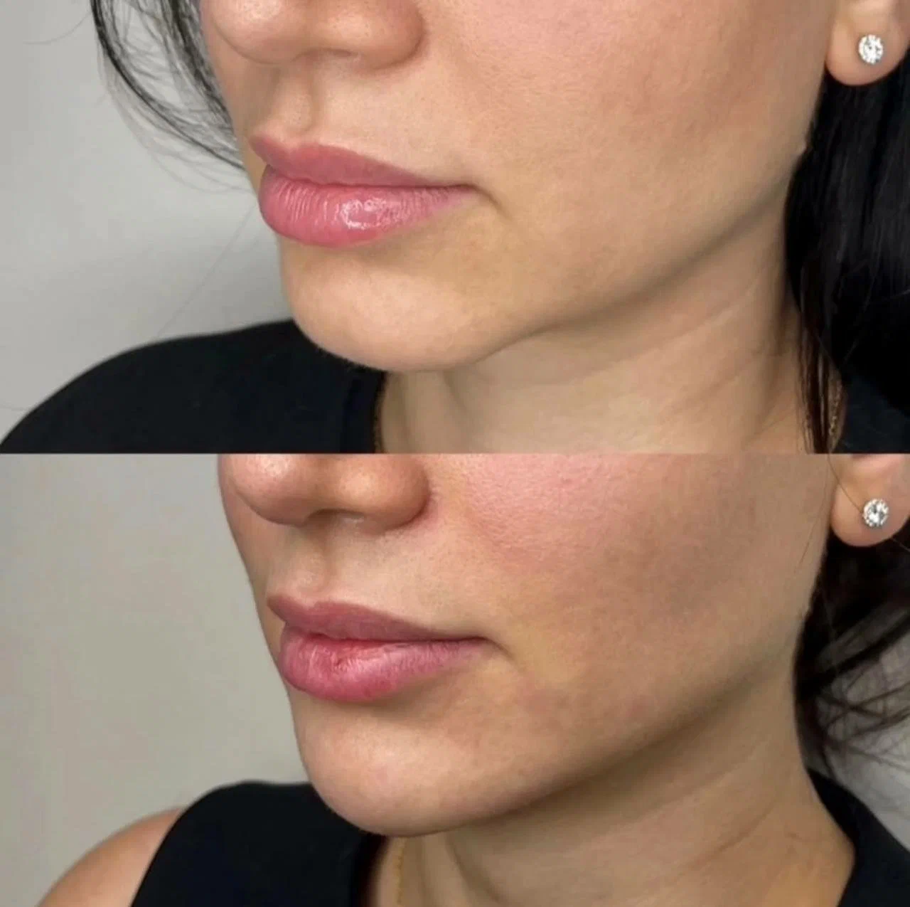 Kairax Filler Treatment before and after results showing fuller and more defined lips.