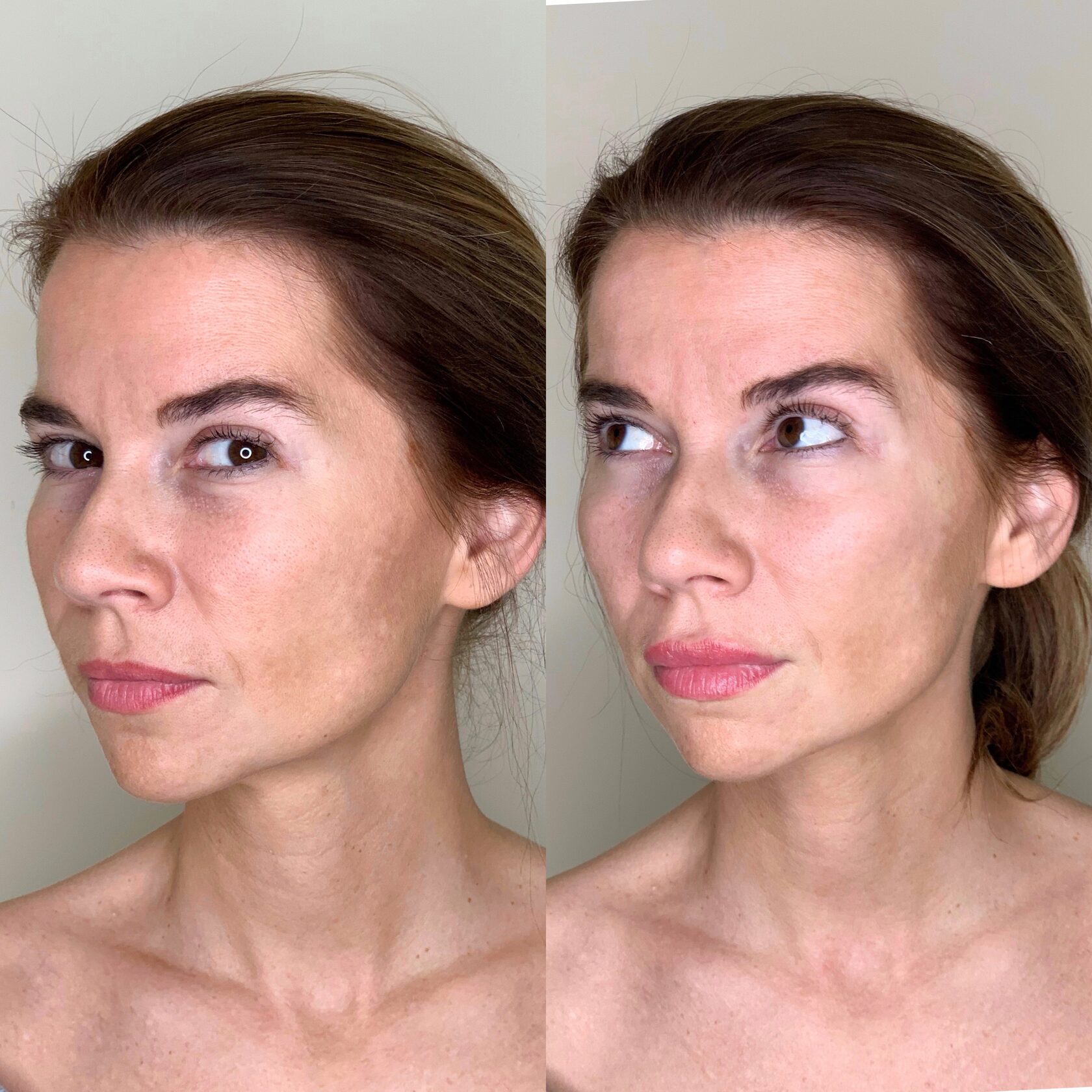 Kairax Filler Treatment before and after showcasing enhanced facial contours and smooth skin.