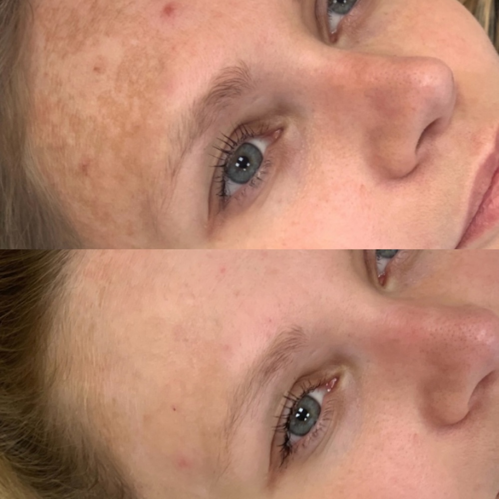 kairax-filler-treatment-skin-improvement