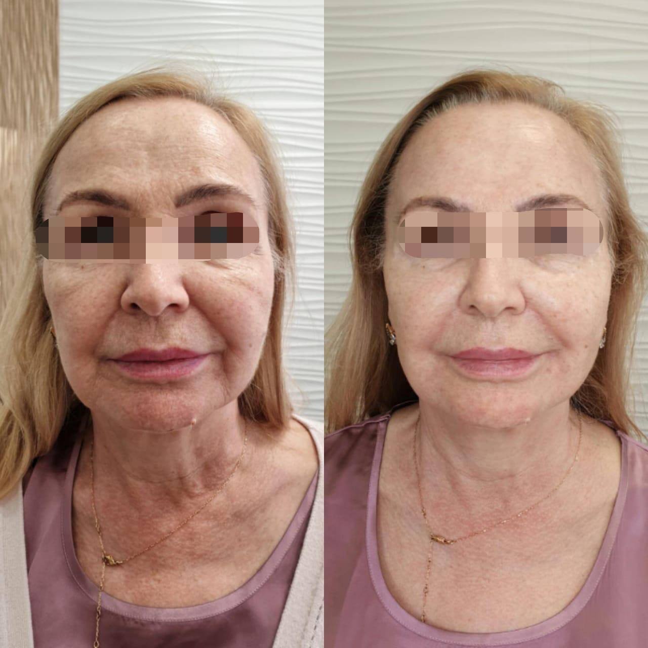 Neauvia Organic Filler Treatment before and after demonstrating smoother skin and enhanced facial contours.