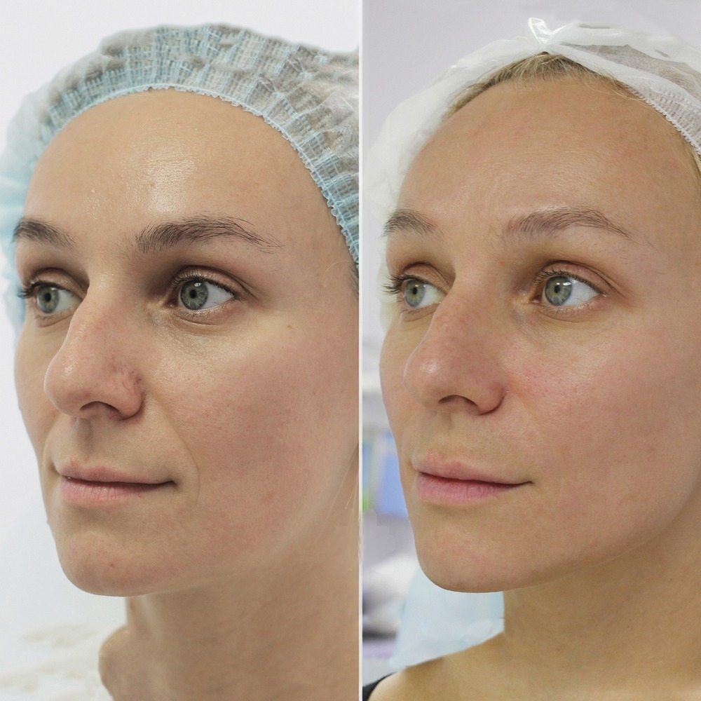 Neauvia Organic Filler Treatment before and after showing improved facial contours and smoother skin.