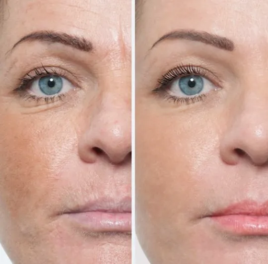 Neauvia Organic Filler Treatment before and after showing smoother skin and reduced fine lines.