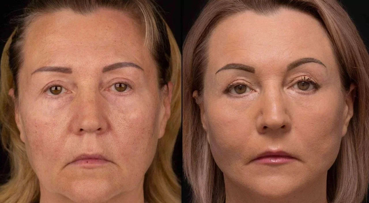 Neuremis filler before and after face lift effect results.