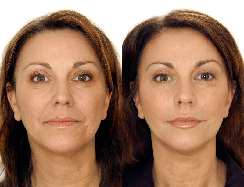 Neuremis filler before and after face rejuvenation results.