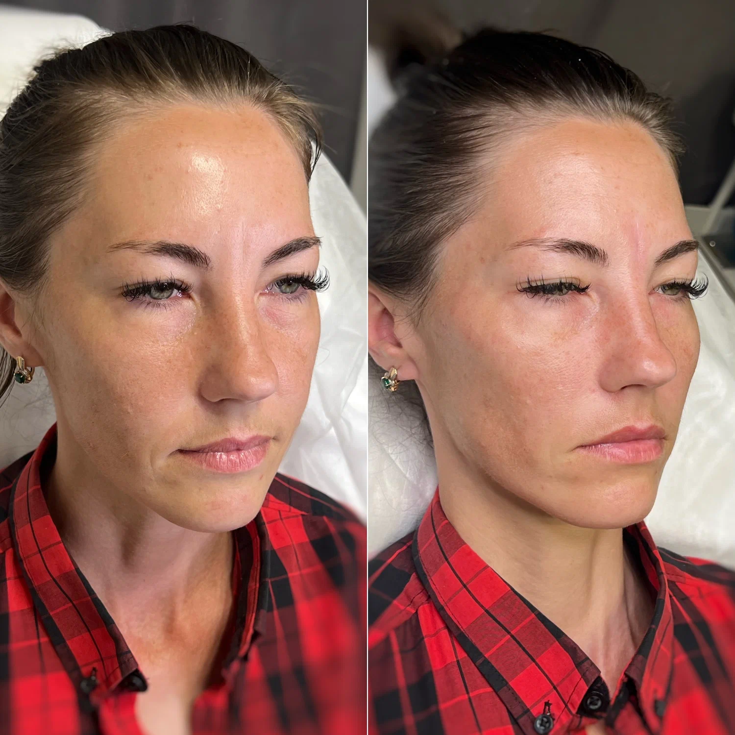 Neuremis filler before and after facial contour enhancement results.