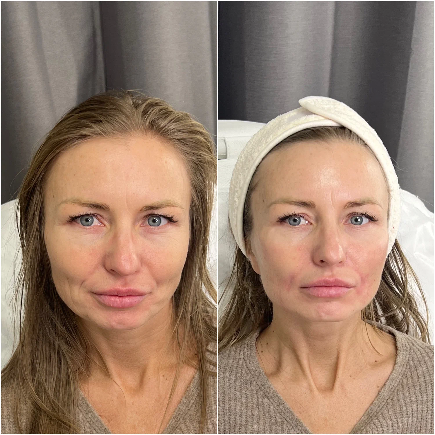 neuremis-filler-before-after-full-face