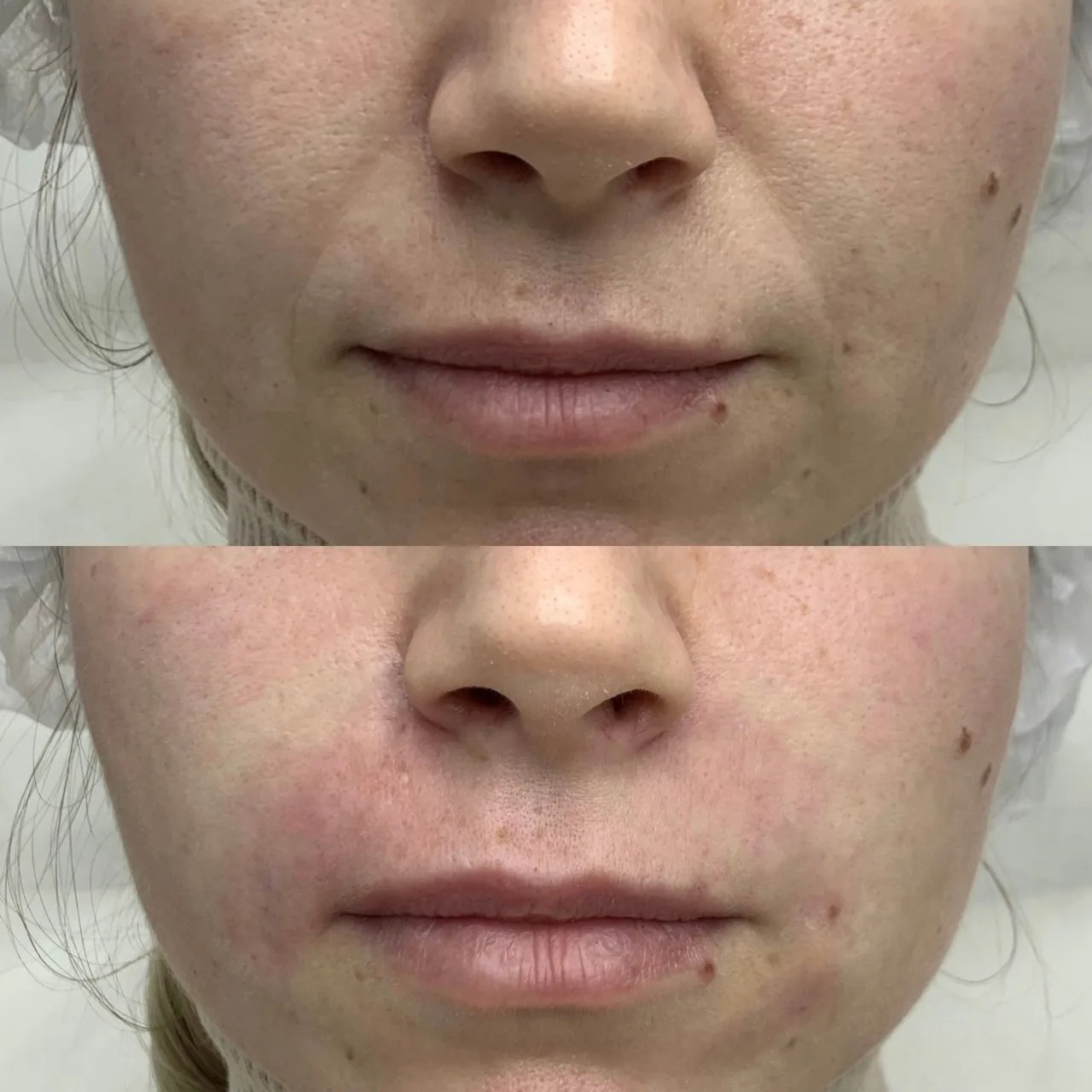 Neuremis filler before and after lip lines treatment results.
