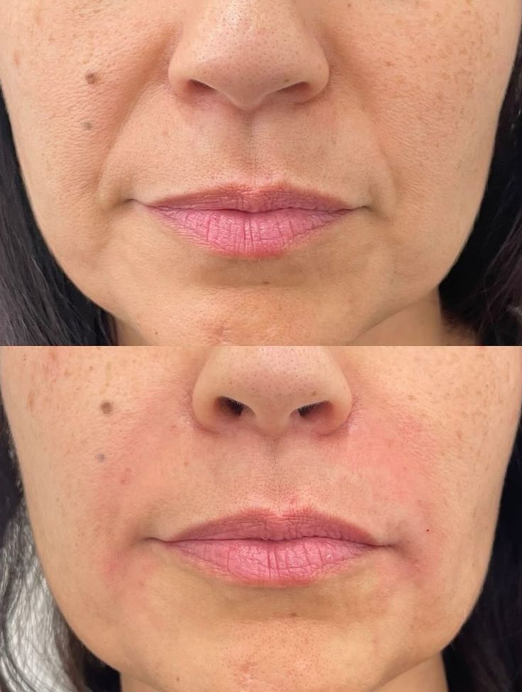 Neuremis filler before and after nasolabial folds correction results.