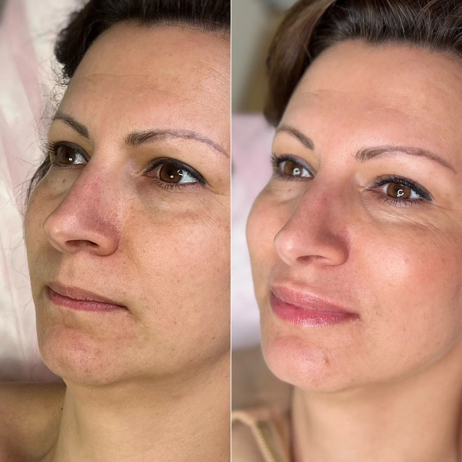 Neuremis filler before and after skin rejuvenation results.