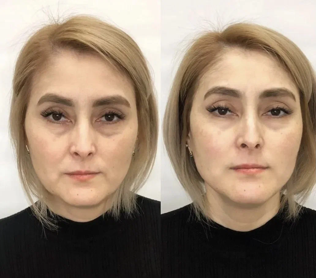 Neuremis filler before and after under eye rejuvenation results.