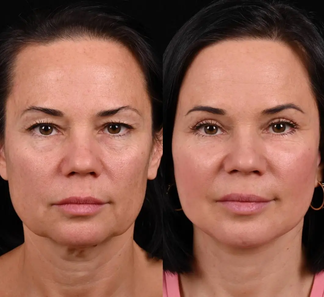 Redensity 2 Filler Treatment before and after results, smoothing skin and reducing signs of aging.