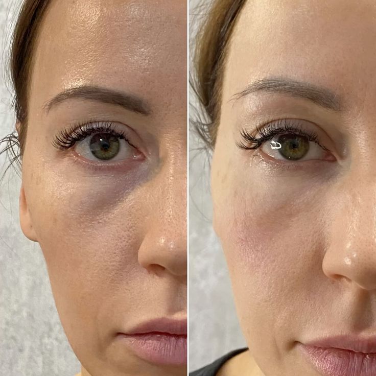 Redensity 2 Filler Treatment before and after, enhancing under-eye area and reducing puffiness.