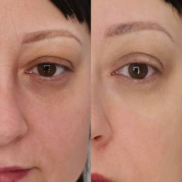 Redensity 2 Filler Treatment before and after enhancing under-eye area and reducing dark circles.