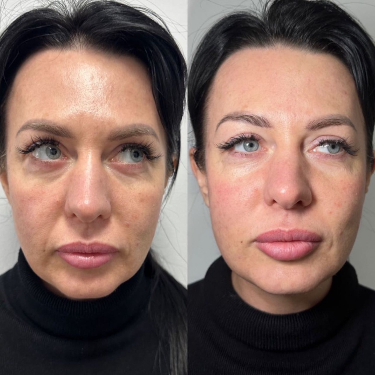 Redensity 2 Filler Treatment before and after, improving facial features and skin smoothness.