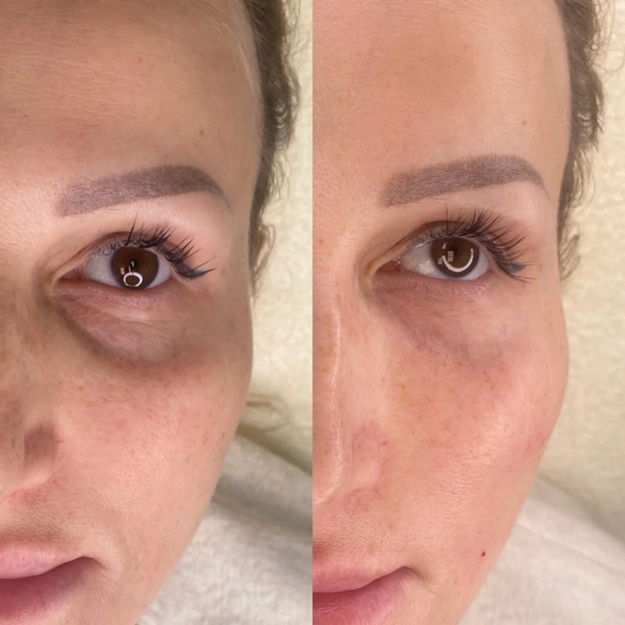 Redensity 2 Filler Treatment before and after, improving under-eye area and reducing dark circles.