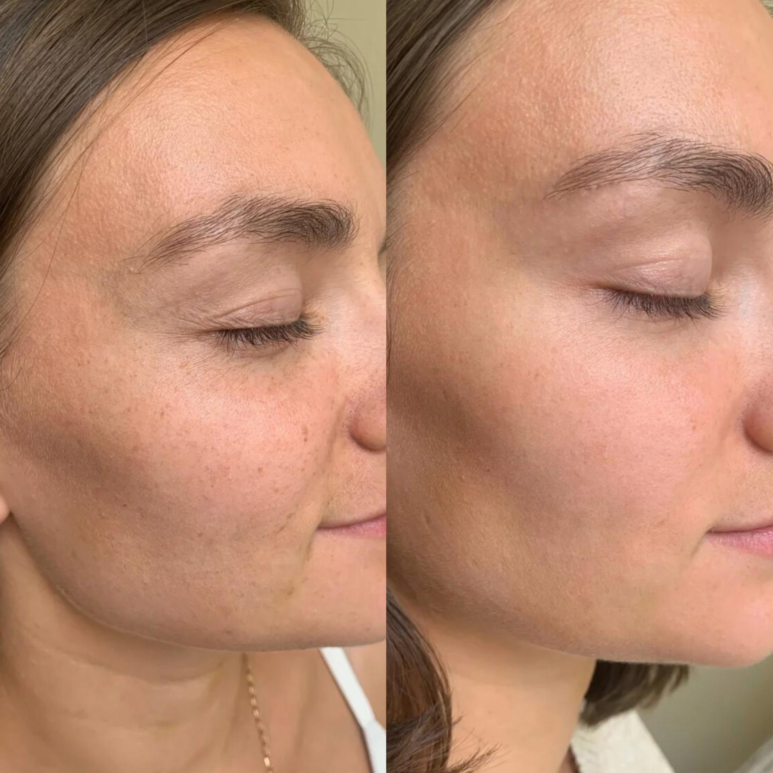 restylane-dermal-filler-cheek-contouring-before-after