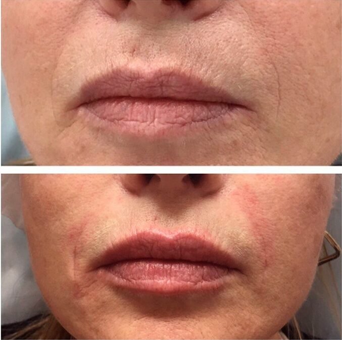 restylane-dermal-filler-lip-enhancement-before-after