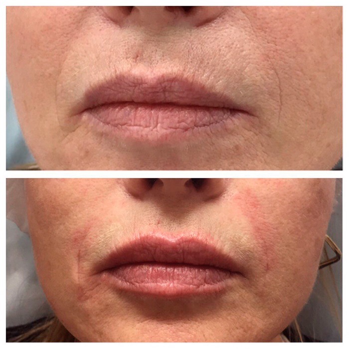 restylane-dermal-filler-lip-enhancement-before-after