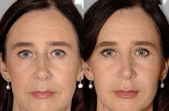Before and after Restylane Dermal Filler Treatment rejuvenating the face with smoother skin and reduced wrinkles.