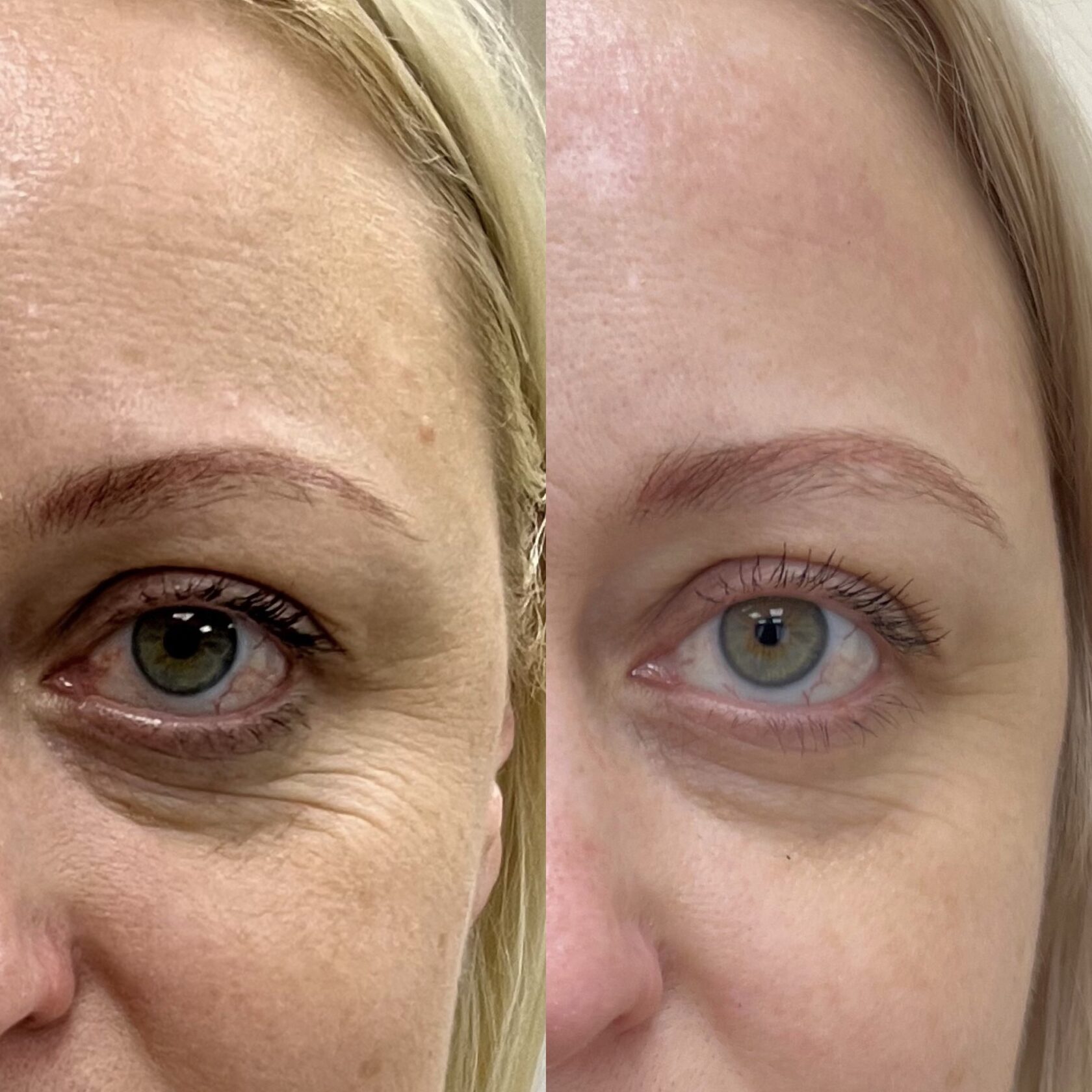 restylane-dermal-filler-treatment-eye-area-before-after