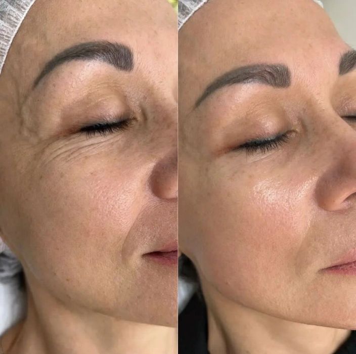 restylane-dermal-filler-wrinkle-reduction-before-after