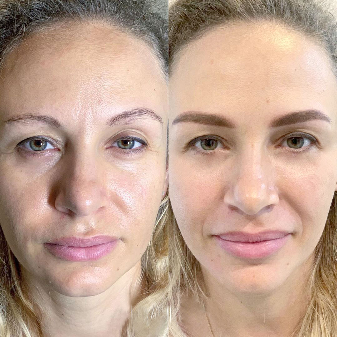 Revanesse Dermal Filler Treatment before and after showing improved skin texture and facial features.