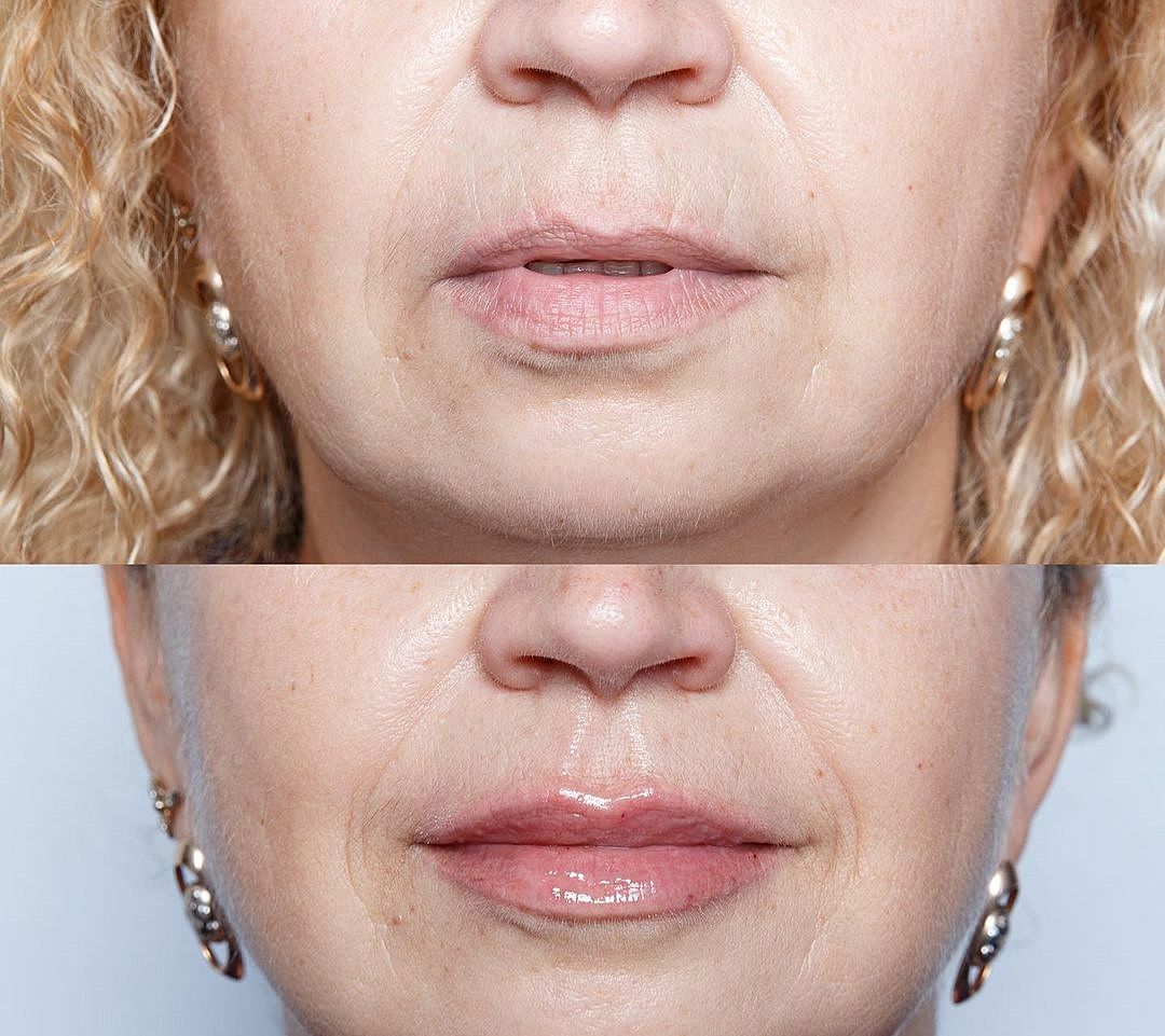Revanesse Dermal Filler Treatment before and after showing fuller lips and smoother skin texture.