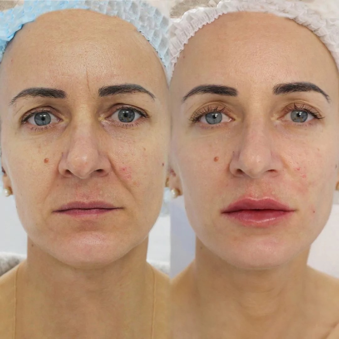 Revanesse Dermal Filler Treatment before and after results with enhanced facial volume and smooth skin.