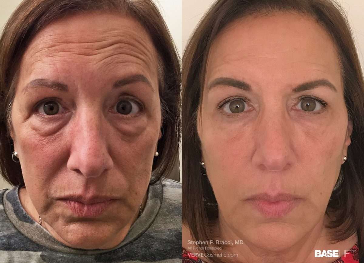 Revanesse Dermal Filler Treatment before and after reducing under-eye bags and smoothing skin.