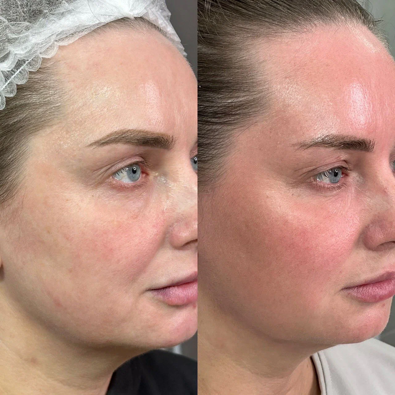 revolax-dermal-filler-treatment-before-after-cheek-contour