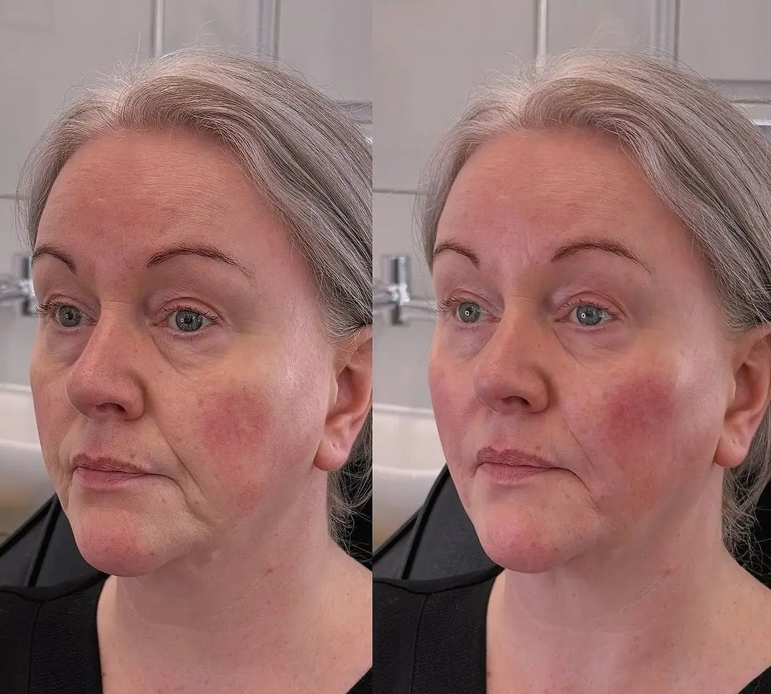 Revolax dermal filler treatment before and after cheeks with improved volume and contour.