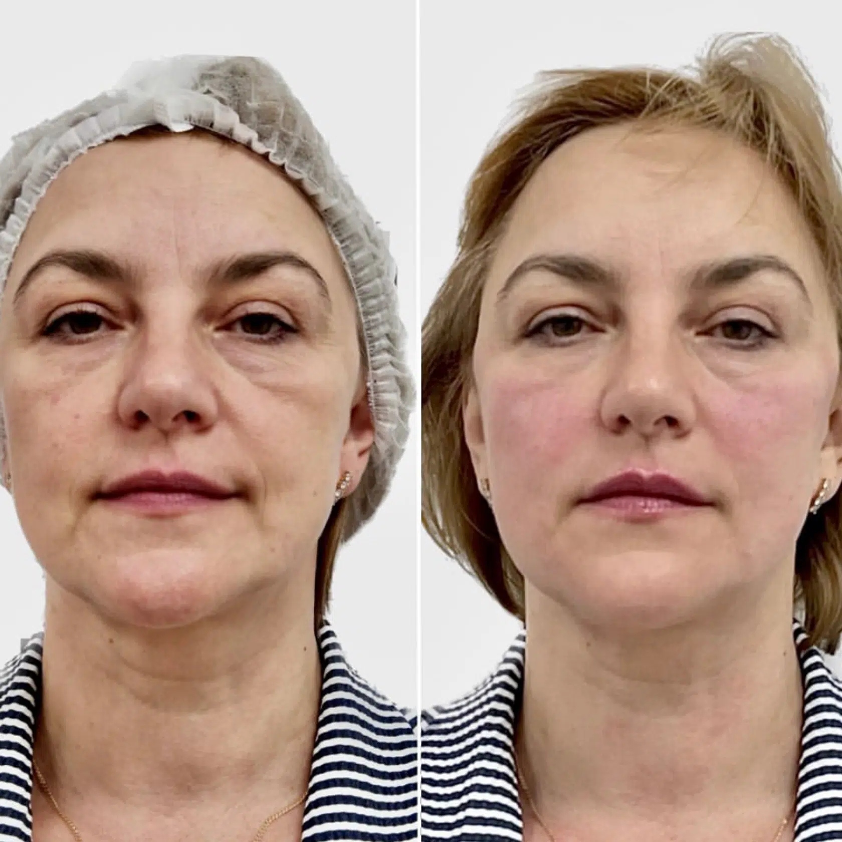 Revolax dermal filler treatment before and after facial rejuvenation with enhanced contour.