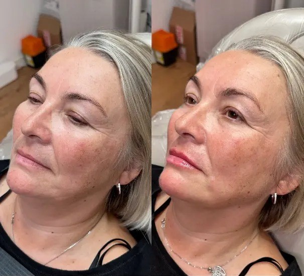 Revolax dermal filler treatment before and after jawline with enhanced contour and volume.