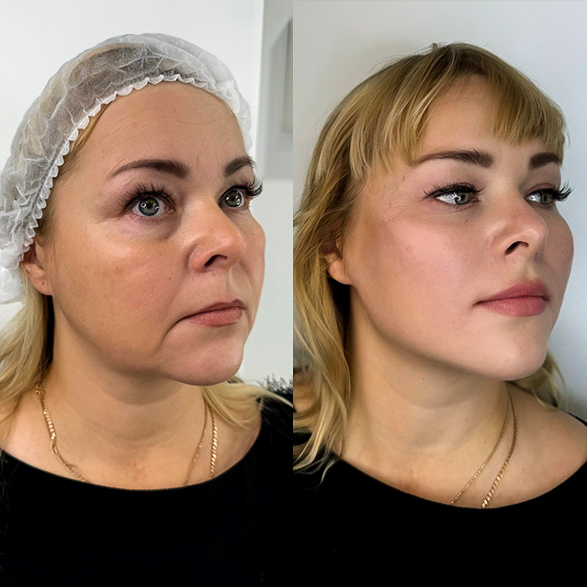 Saypha filler treatment before and after cheeks and jawline with improved contour and volume.