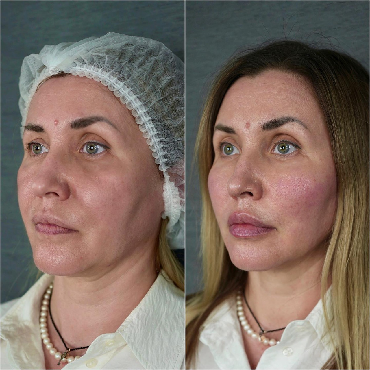 Saypha filler treatment before and after cheeks and lips with improved volume and contour.