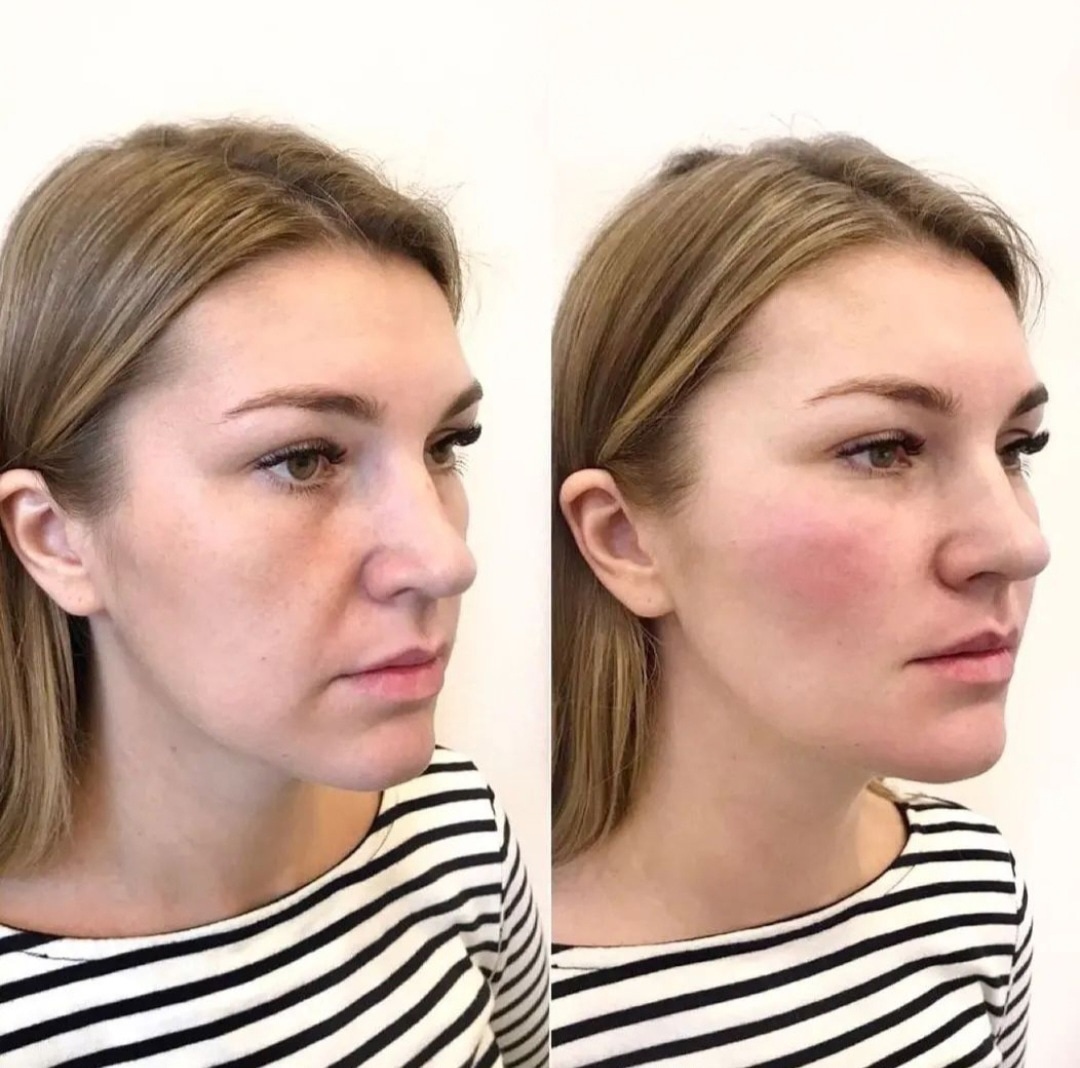 Saypha filler treatment before and after cheeks with improved contour and volume.