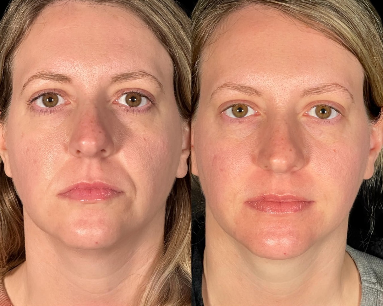 Saypha filler treatment before and after full face with improved volume and smoother skin.
